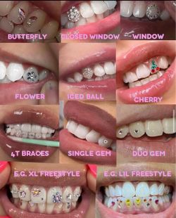 Tooth gems