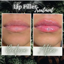 Self Care Summer Sale (Lash Extension, Lip Filler, Teeth whitening)