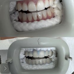 Teeth Whitening
