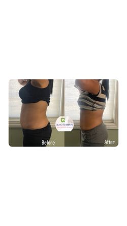 Body Sculpting
