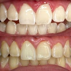 Teeth Whitening