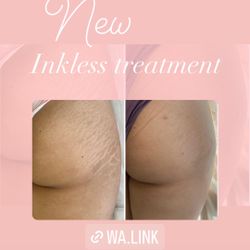 strech marks REMOVAL