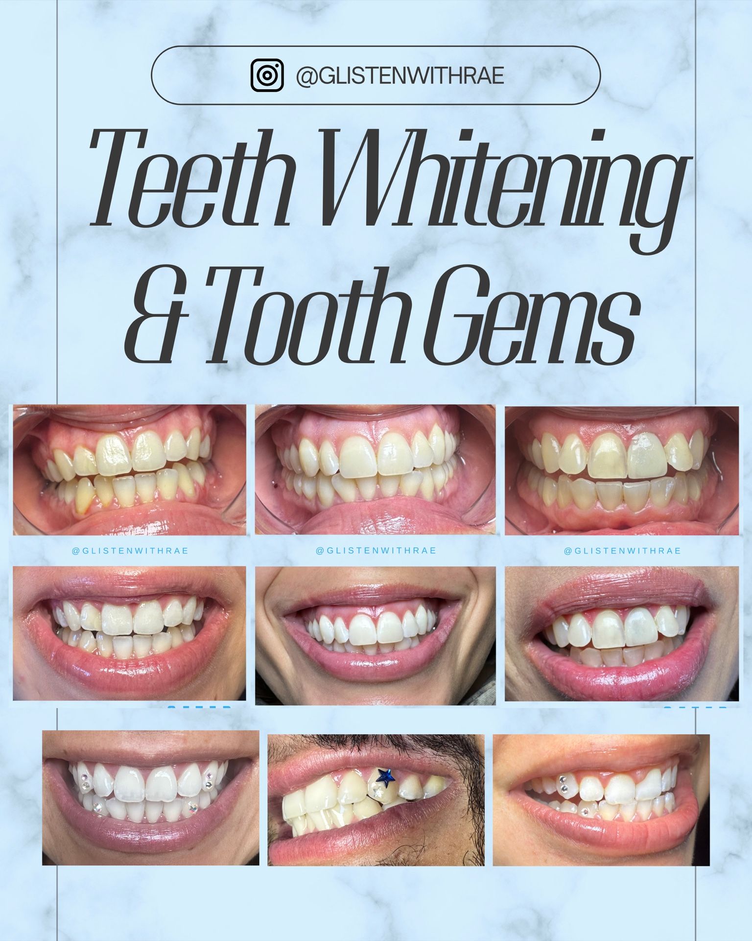 Teeth Whitening & Tooth Gems Available