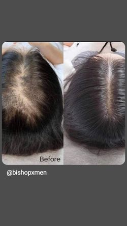 Solution For Hairloss