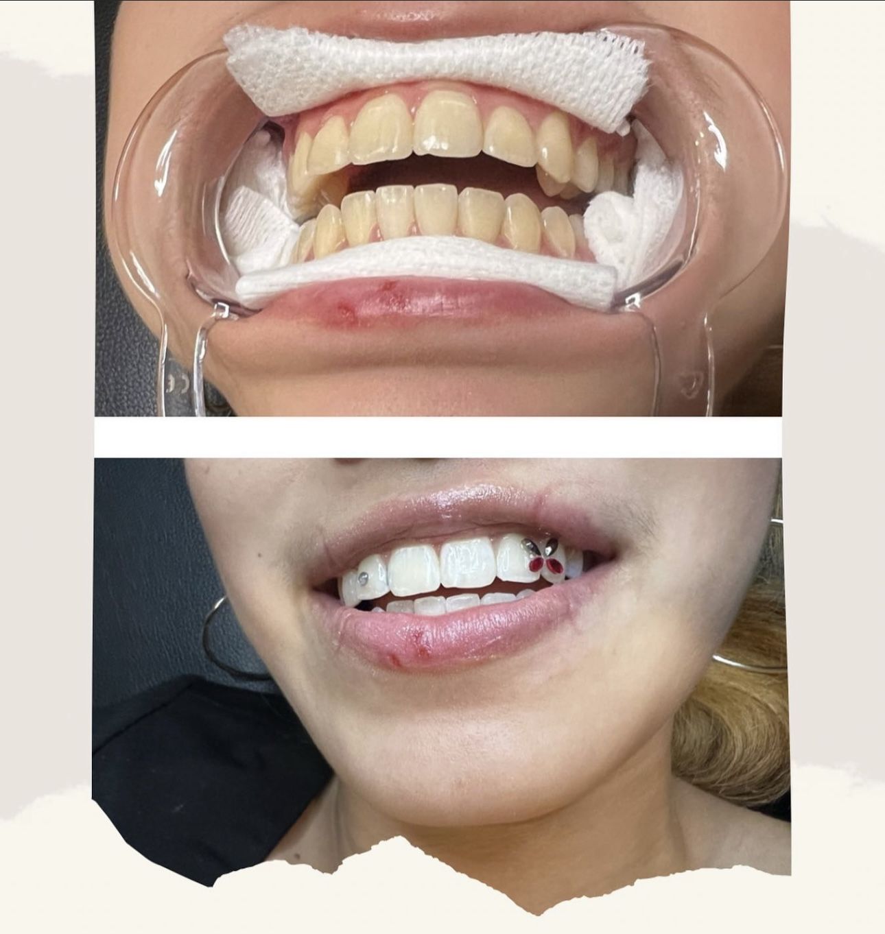 Blanquiamiento De Dientes