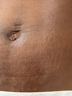 Stretch mark removal