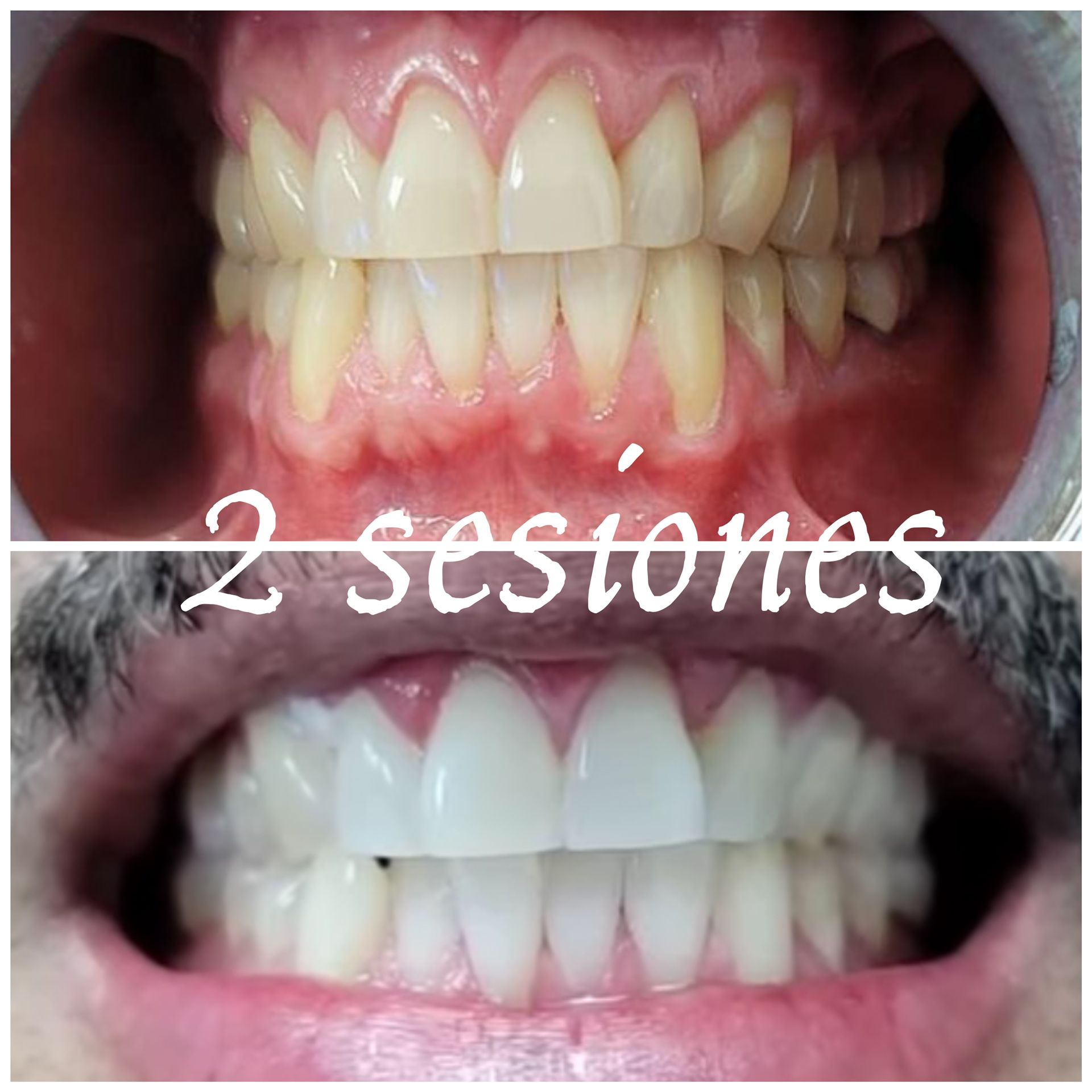 Teeth Whitening Express Adomicilio 