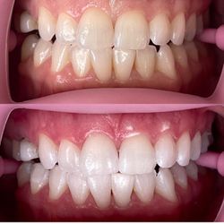 Illuminating Whitening teeth 