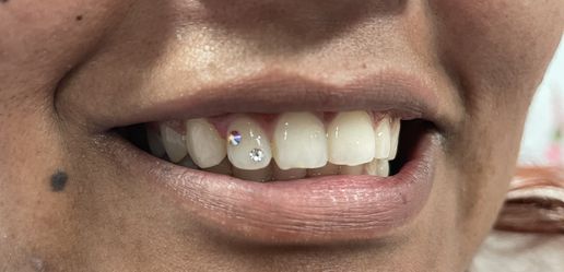 Tooth Gems (Joyas En Los Dientes)