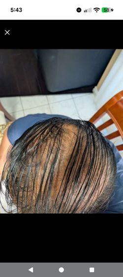 Hairmax LaserComb, Hair Regrowth