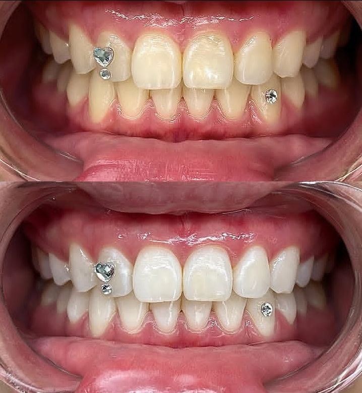 Teeth whitening pmu lips and brows