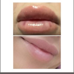 Hyaluron Lip Fills