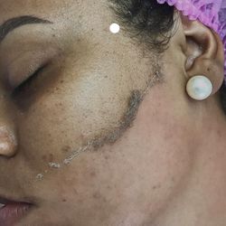 Dermaplaning Facials 