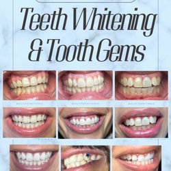 Teeth Whitening & Tooth Gems Available