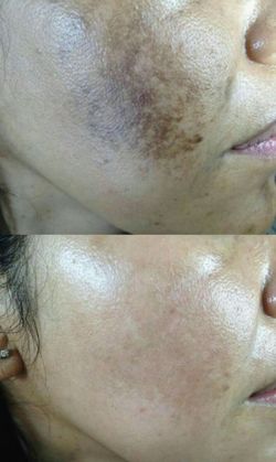 Facial de Laser Co2