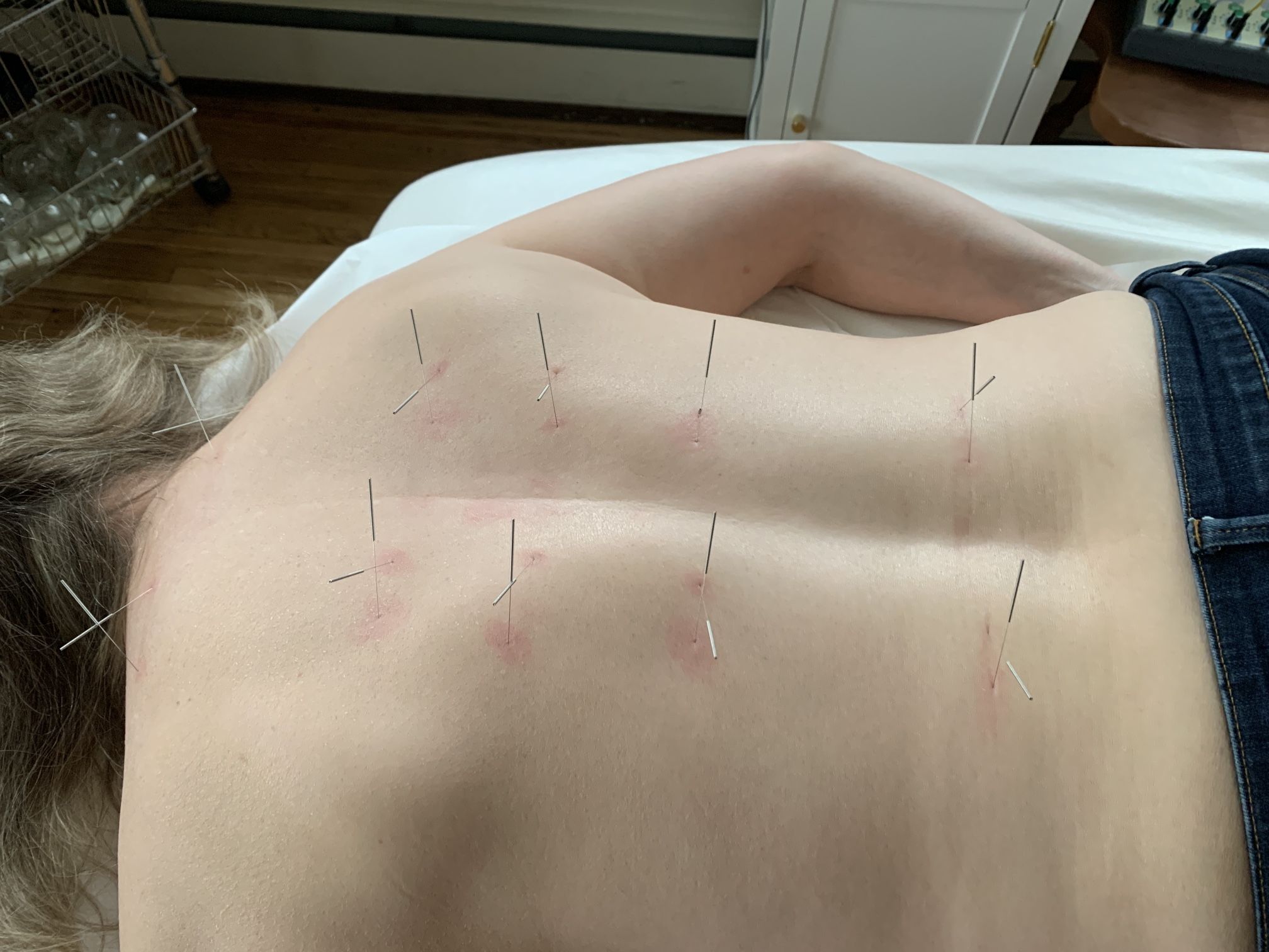 Acupuncture