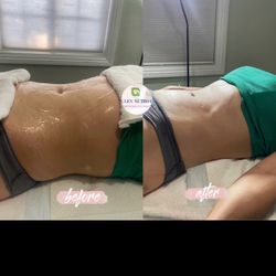 Body Sculpting Cavitation Wood Therapy And More