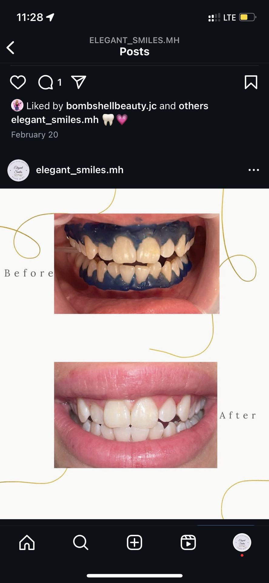 Teeth Whitening