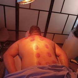 Cupping Therapy Massage