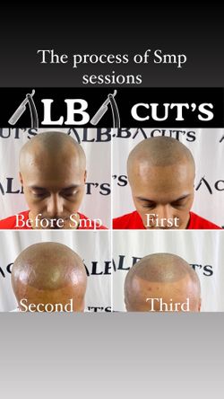Scalp MicroPigmentation  Pigmentación Capilar Smp. Loose The Hat And Look Younger , Quiere Verse Más Joven 