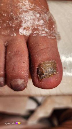 Pedicura ONICOMICOSIS 