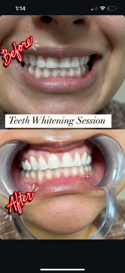 Teeth Whitening