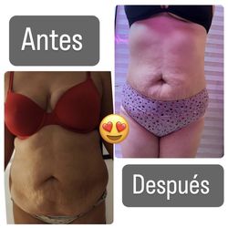 Reductivos con aparatologia