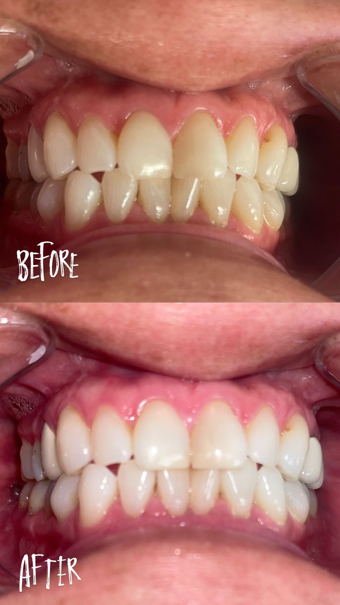 Whitening