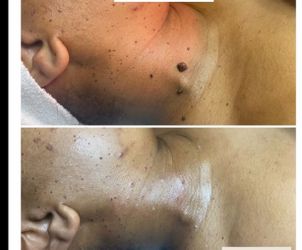 skin tag Removal