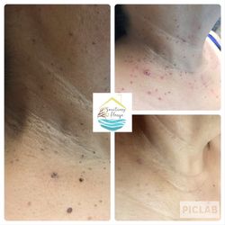 Skin tag removal