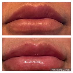 Lip Fillers