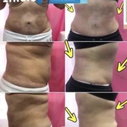 Masajes Reductivos Body Sculpting 