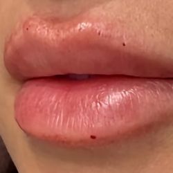 Lip Filler 