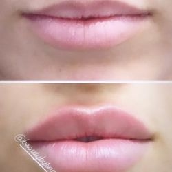 Lip Filler Lip Injections 