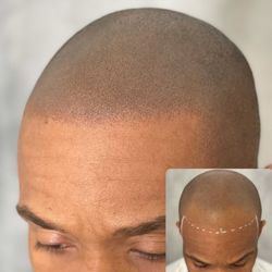 SMP Models Needed - Scalp Micropigmentation