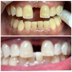 Teeth whitening