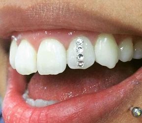 Tooth Gem