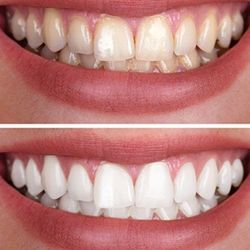 Professional Teeth Whitening 
