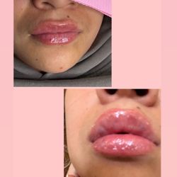 Hyalouron Lip Filler