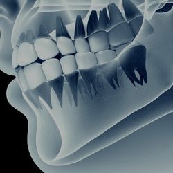 FREE FREE FREE POLISHING AND CLEANING AND XRAYS