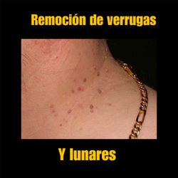 Remoción de verrugas