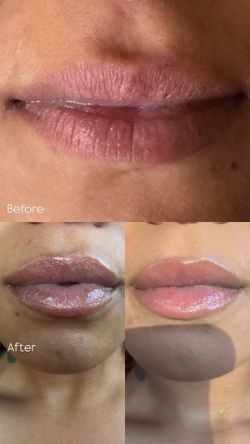 Lip flip or Botox