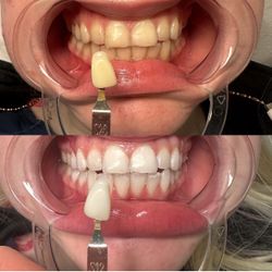 Whitening Teeth