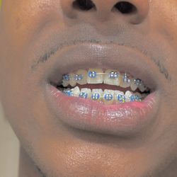 Fashion Braces 