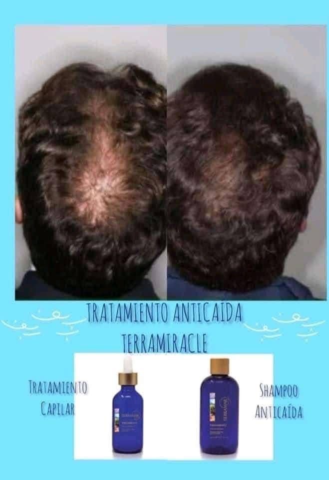 Caída Del Cabello