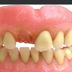 DENTURE or Partial Broken?