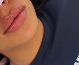 Lip filler