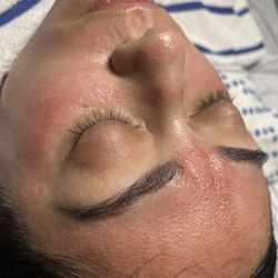 Micro needle facial serum