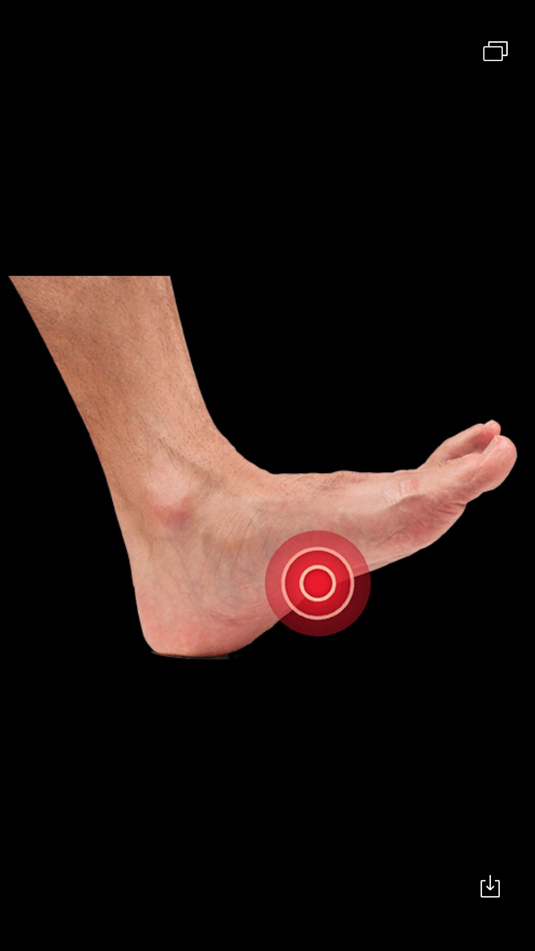 Plantar fascitis