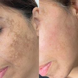 Disminuye El Paño En La Cara O Melasma 
